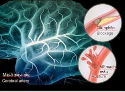  Tìm hiểu về bệnh tai biến mạch máu não.